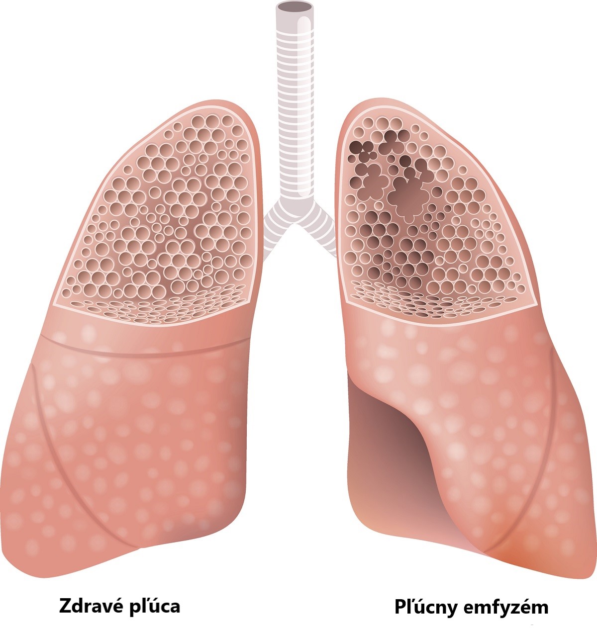 Znázornenie zdravých pľúc v porovnaní s pľúcnym emfyzémom. Zdroj foto: Getty Images